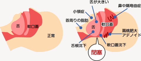 睡眠時無呼吸症候群